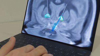 Electrodos en el cerebro devuelven la vida a un joven con Tourette