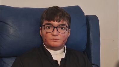 Pacientes de piel de mariposa, felices al recibir el nuevo 'oro' medicinal que les mejora