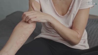 Las alergias crecen sin freno: ya afectan a casi la mitad de la población