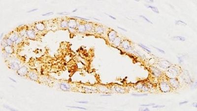 Detectan el cáncer de páncreas en minutos y con una muestra de sangre