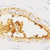 Expresión de la proteína sAXL en tumores pancreáticos