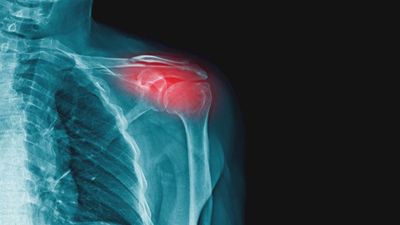 Artritis: síntomas, tratamientos y diferencias con la artrosis