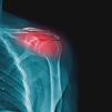 Artritis: síntomas, tratamientos y diferencias con la artrosis