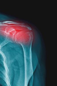 Artritis: síntomas, tratamientos y diferencias con la artrosis