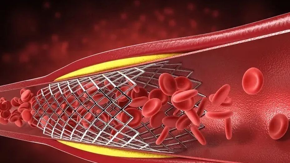 Madrid invierte 40 millones en stents coronarios para reforzar el tratamiento de enfermedades cardiovasculares