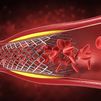 Madrid invierte 40 millones en stents coronarios para reforzar el tratamiento de enfermedades cardiovasculares