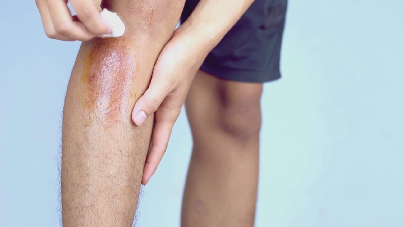 ¿Qué hacer cuando un niño se hace una herida? Guía para curarlas este verano