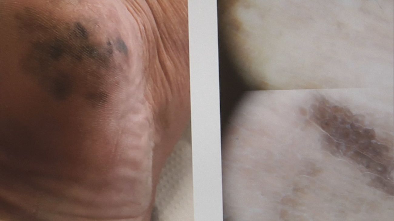 La primera vacuna contra el cáncer de piel supera con éxito una última fase de ensayo