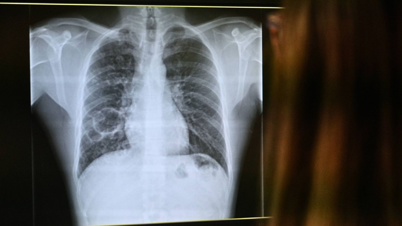 La tuberculosis presenta una tasa cuatro veces mayor entre los nacidos fuera de España, según el CCAES