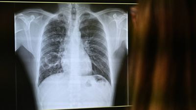 La tuberculosis presenta una tasa cuatro veces mayor entre los nacidos fuera de España, según el CCAES