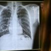 La tuberculosis presenta una tasa cuatro veces mayor entre los nacidos fuera de España, según el CCAES