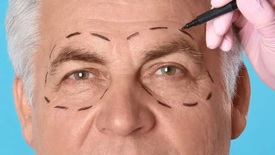 La cirugía de párpados lidera como la intervención estética más popular en hombres y mujeres